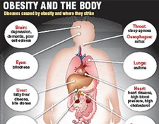 Obesity treatment is prevention