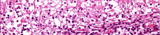 Bacterial Meningitis