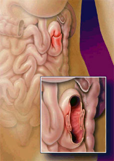 Small Bowel Intussusception