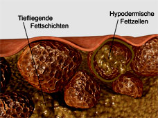 Skin in Cellulitis