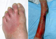 Skin in Cellulitis sidebanner