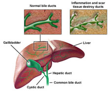 Primary sclerosing cholangitis