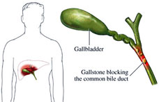 bacterial infection