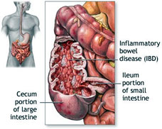 inflammatory bowel disease