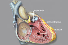 Congenital-Heart