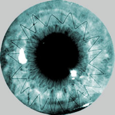 Diseases B Corneal-Graft