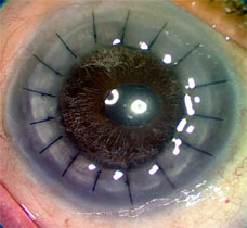 Corneal Transplant