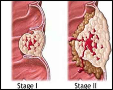 diseases brain cancer