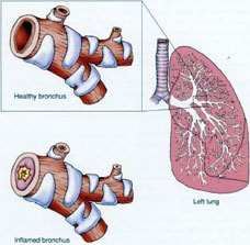 Bronchitis infected by bacteria