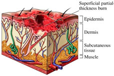 Thickness Burns