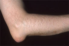 Olecranon Bursitis