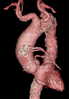 damaged coronary artery