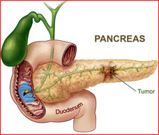 Pancreatic cancer