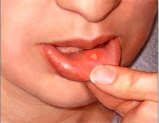 Canker Sore