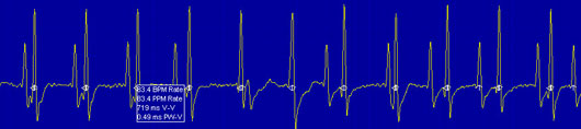 Cardiac Pacemaker