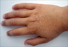 child with celiac disease