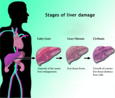 cirrhosis