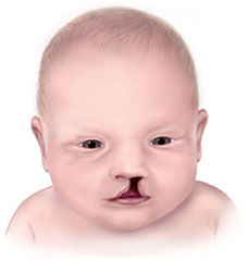 Baby with cleft lip