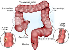 Colon Cancer & Polyp