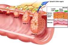 Colorectal Cancer Staging