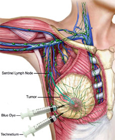 Sentinel Lymph Node Detection