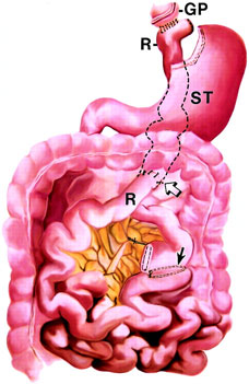 Constipation An inability