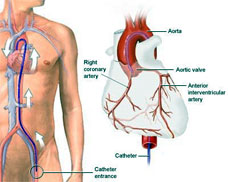 Coronary Artery Disease