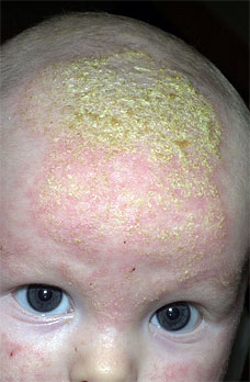 cradle cap images