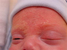 Symptoms of Cradle Cap