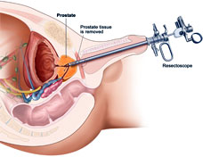 Prostate Cancer