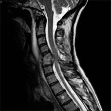 Discitis osteomyelitis