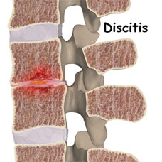 Discitis