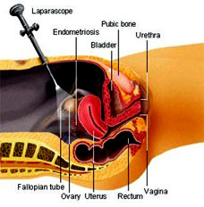 Abnormal uterine bleeding