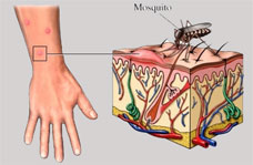 Mosquito Bite