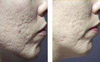 Acne scarring