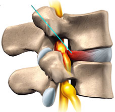 Lumbar Disc Herniation