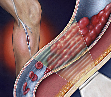 Deep Vein Thrombosis