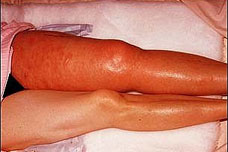 Deep vein thrombosis symptoms appear