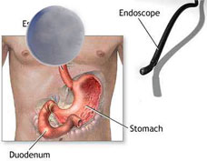 Bleed during endoscopy