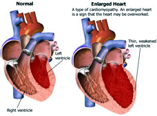 Sided Heart Failure