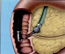 Sphincterotomy