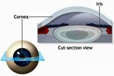 Lasik Eye Surgery