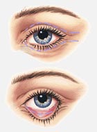 Eyelid Surgery