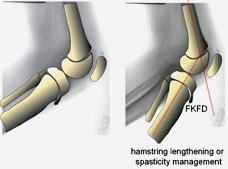 Hamstring recession