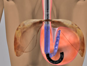 Pain in the upper abdomen