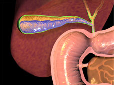 Gallstones 