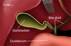 gallstone attack 