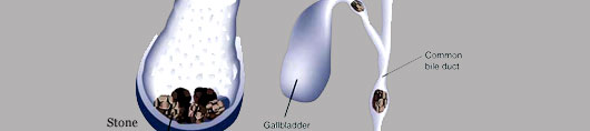 Gallstones