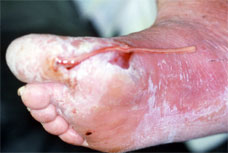 diabetic foot