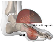 Uric acid crystals